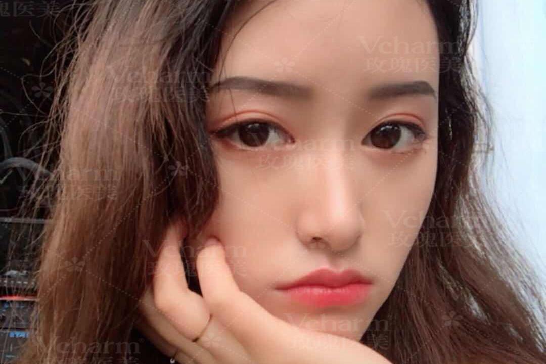 为什么双眼皮松弛下垂了呢?