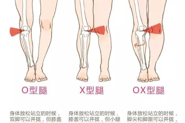 腿型矫正系列——每天10分钟,这个动作可以帮你轻松矫正xo型腿