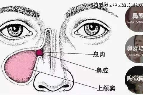 你知道鼻息肉有多可怕吗?有六大并发症,而且手术割掉还会长!