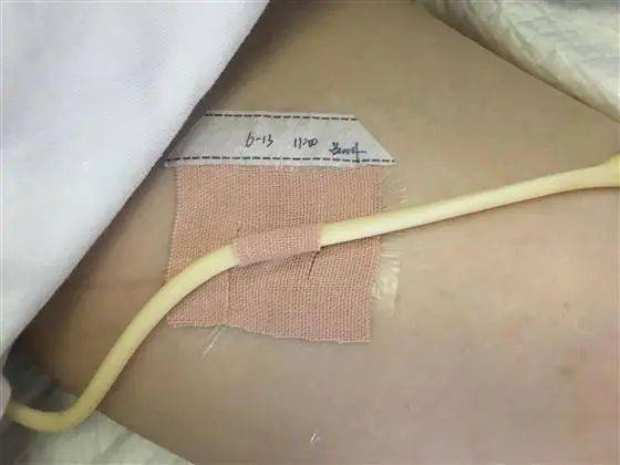 活久见，尿管原来可以插到了阴道里，也会在膀胱里打结