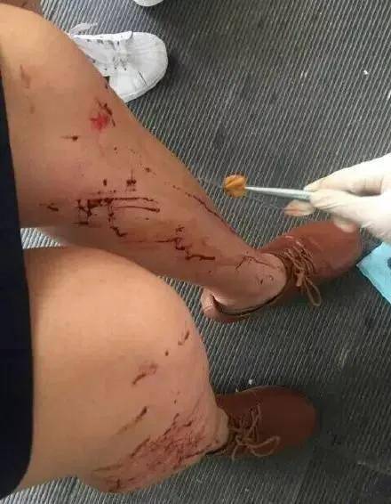 有人的腿部被玻璃碎片溅到,受伤流血.