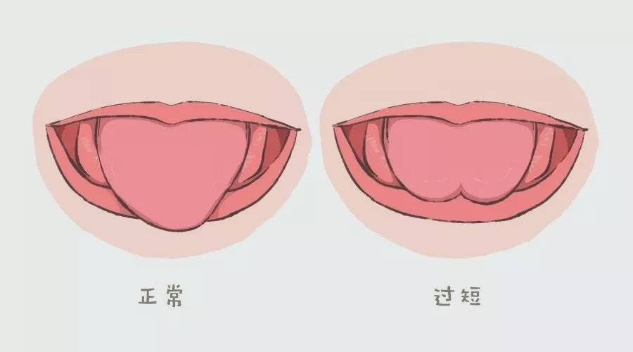『发音』剪还是不剪？捏积派——孩子话讲不清楚可能与舌系带短有关
