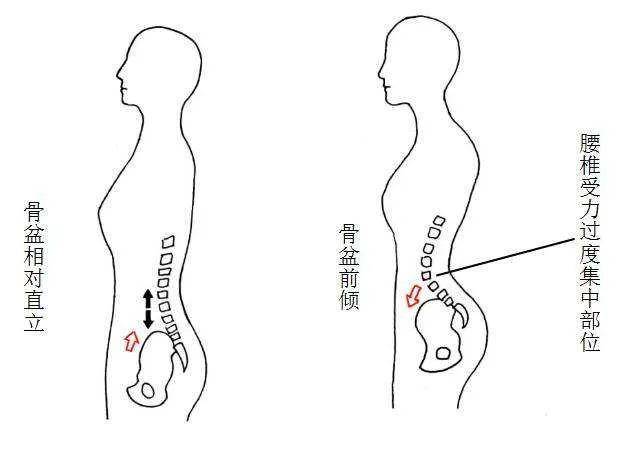 挛缩,肌力平衡被打破而表现出的下腹前突,腰部塌陷,臀部上翘的异常