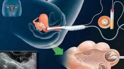 试管婴儿胚胎移植怎么选择