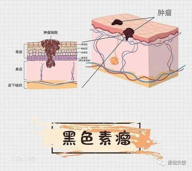 不起眼的痣很有可能演变为恶性肿瘤:黑色素瘤