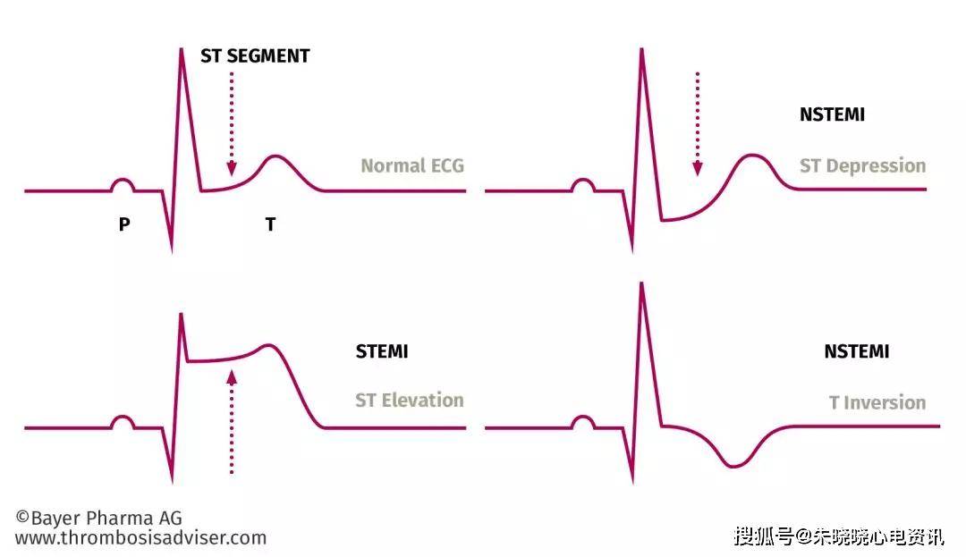 st段抬高型心肌梗死与非st段抬高型心肌梗死