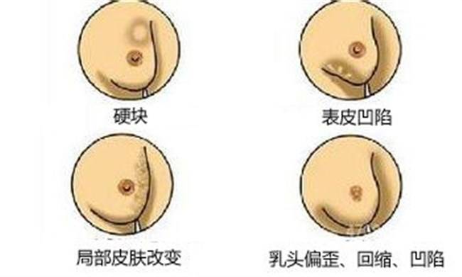 乳腺癌早期的体征与常见表现_乳头