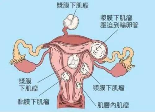 有长在子宫上的,如:子宫肌瘤,子宫腺肌瘤,子宫腺肌症等;有长在卵巢上