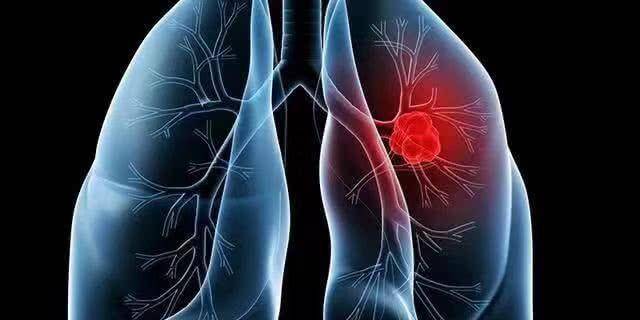 如何预防肺部问题 8eac126dca7948c39809b2f7ecc1a83b.jpeg