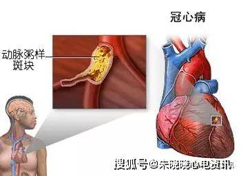 教您辨别冠心病心绞痛心肌梗塞三者关系