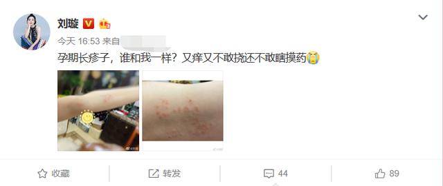 孕妇不易，刘璇二胎孕期满手臂红疹子奇痒难忍，网友劝其尽早就诊