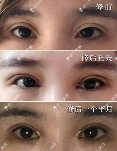 怎么翻眼皮教程 5263c6abd0744ef69a864b7a7073a7cc.jpeg