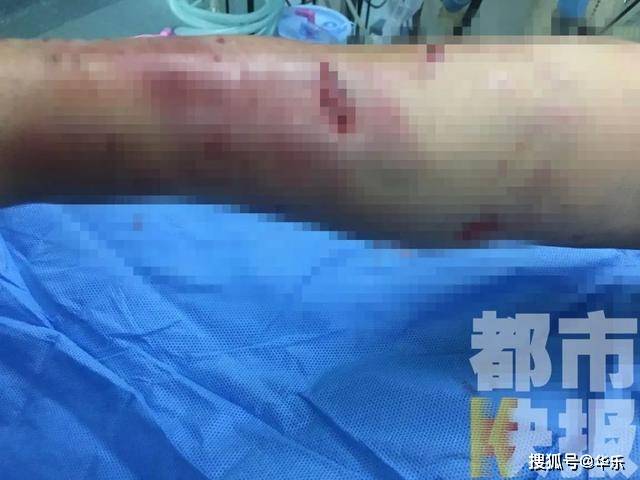 西安女子被自家狗咬成狂犬病,身受重伤,网友:为什么要