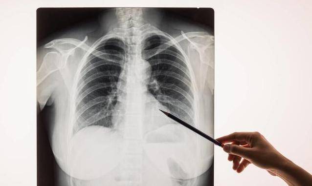 预防肺癌,最好选择肺部ct,而"拍胸片"对早期肺癌来说,漏诊率很高.