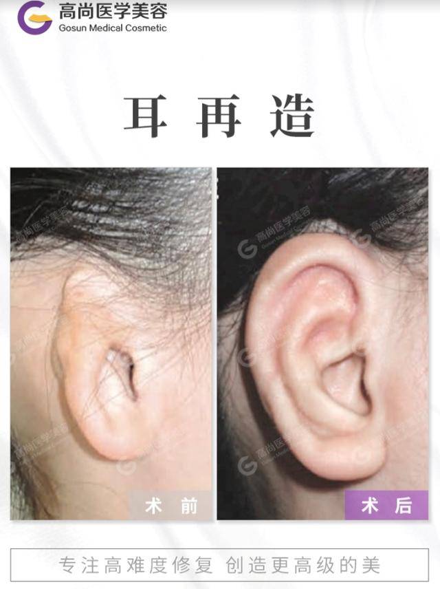 小孩耳朵畸形可致孩子"自闭症",应及早进行耳朵整形手术