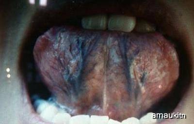 原创舌头出现这种症状,提示你体内瘀血过多,用它却能保持血脉畅通