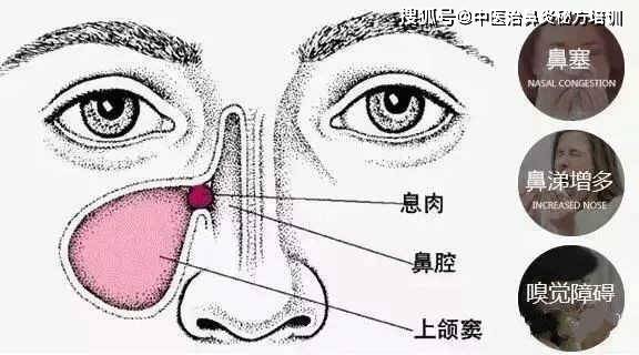 2,咳嗽,多痰:鼻涕状态变得稠厚,多呈现粘液性或粘脓性的状态.