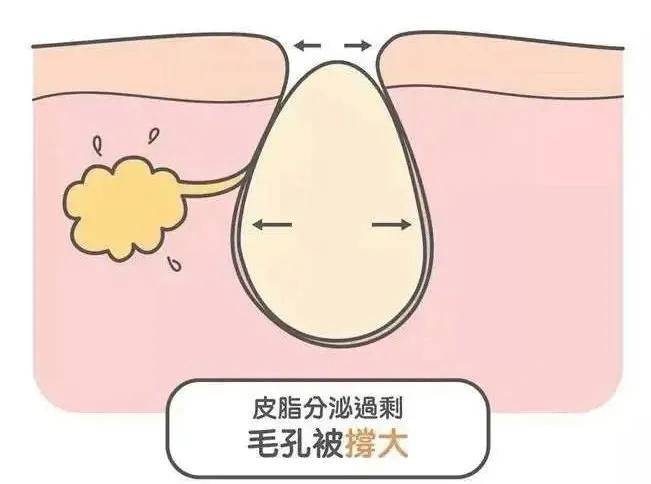 昕芙康:听说你毛孔大到可以放芝麻,该怎么办?