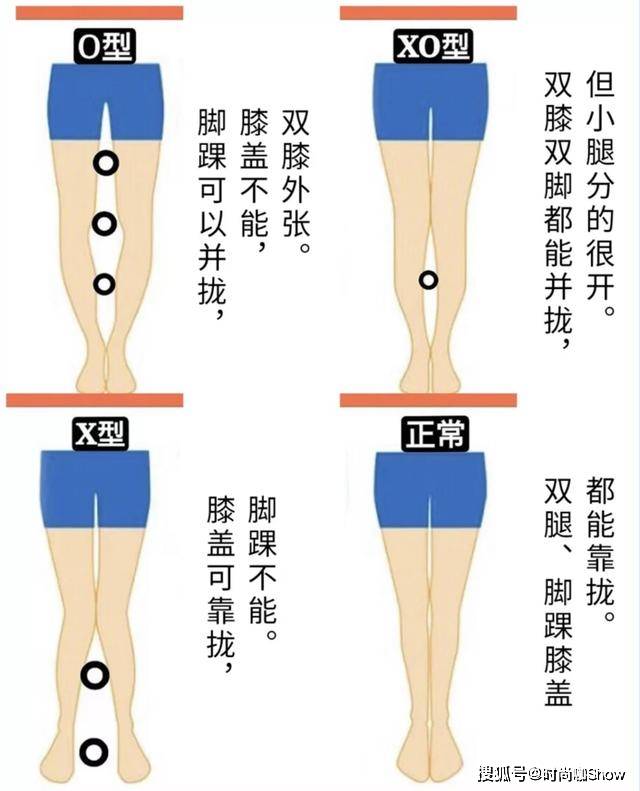 考虑到有些姐妹分不清, x型腿和o型腿的区别,先用一张图来给大家解说