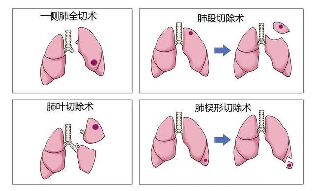 肺腑之谈，胸中有术”——肺癌手术的常见方式及术后并发症_手机搜狐网