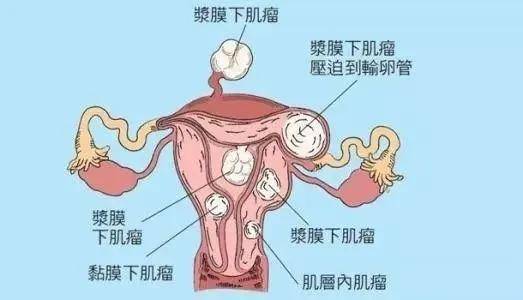 身体有这几种症状,可能是子宫肌瘤的表现!