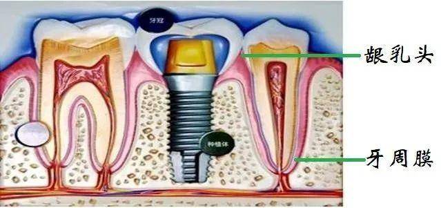 种牙是暴利?关于种牙,牙医绝对不会告诉你这几个真相