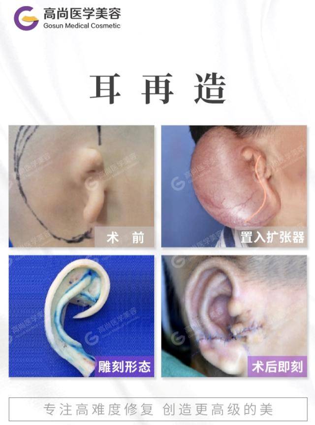 耳再造手术埋置扩张器造耳有哪些注意事项？