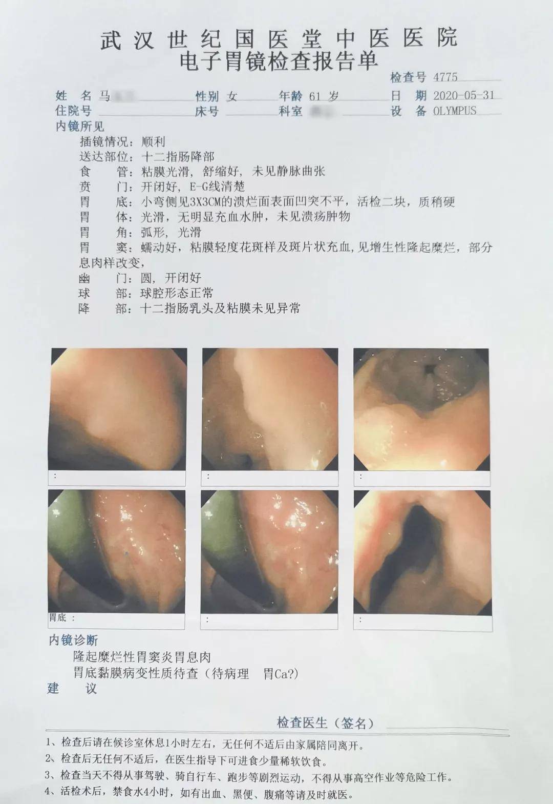 胃癌早期会因为肿块的出现而导致上腹部不适,表