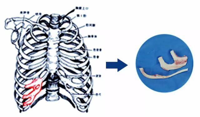 做耳再造，取肋骨对身体伤害大吗？