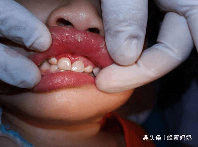 乳牙|重要时刻能“救命”？没这么简单宝宝“乳牙”掉了先别扔