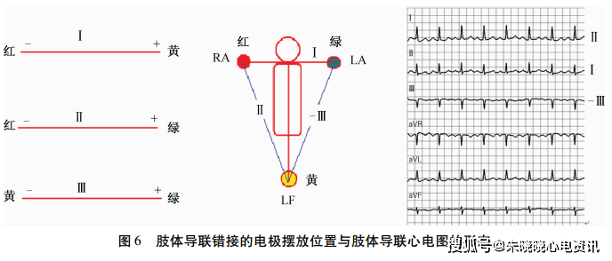 图解肢体导联电极错接的心电图表现