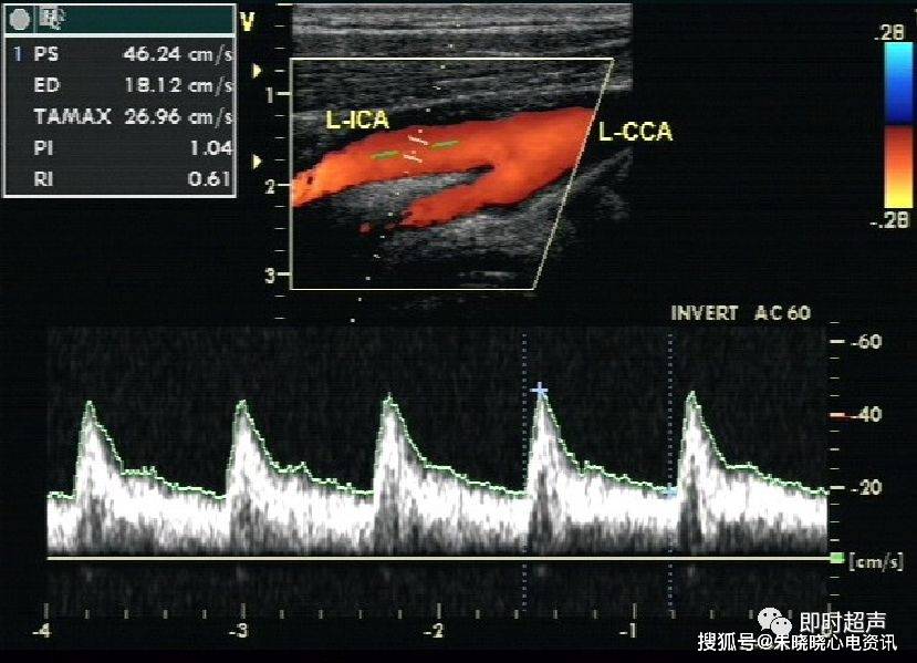 像图表现和多普勒血流频谱曲线 正常颈总动脉及分支彩色多普勒血流图