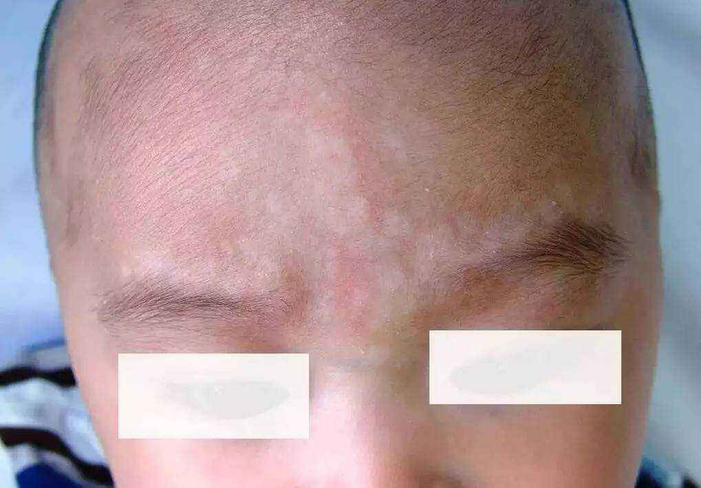 孩子脸上长白斑,都是蛔虫惹的祸?这些皮肤病要警惕
