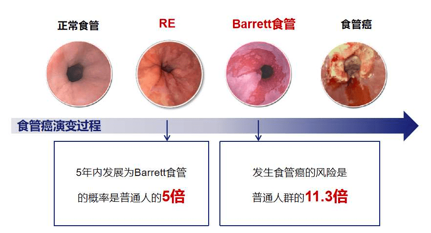 如果患者是中老年人,发病时间不规律,以往无反流性食管炎病史,但有