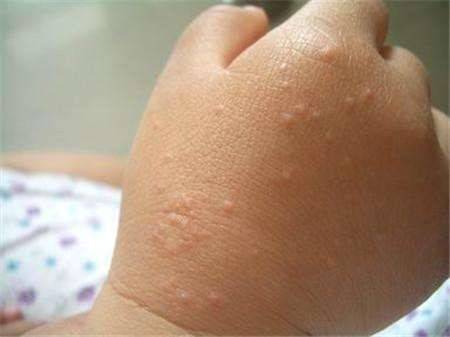 典型的中国儿童的沙土皮炎 01.发病年龄:儿童多见,在2-9岁高发.