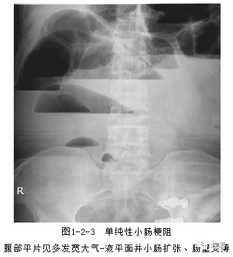 急性肠梗阻可在腹部立位x线平片看到梗阻部位以上的肠管内存在气-液