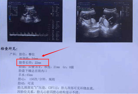B超單上這2個數據，隱藏著胎兒這麼多信息，不會看就吃虧了。《網路文章》