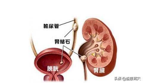 本来得了尿结石的我疼痛难忍打算开刀却没想到这样排出来了