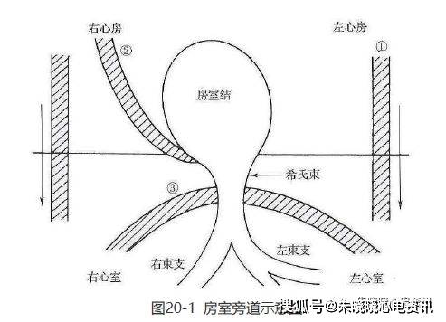 预激综合征解剖学基础是房室旁道的存在,典型的预激综合征是存在kent