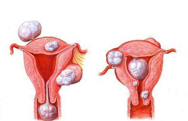 当子宫肌瘤变成子宫肉瘤怎么办?