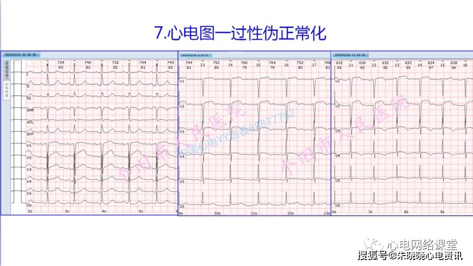 不典型心肌梗死的心电图改变