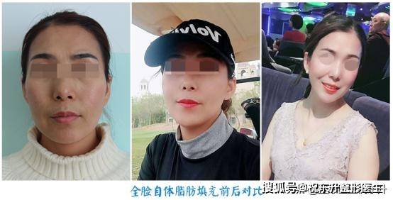 填平了脸上的这些"凹陷",找回了年轻时的感觉