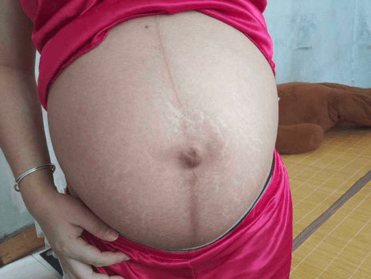 为何孕中期，肚子还是不显怀呢？孕期腹部足以说明什么？