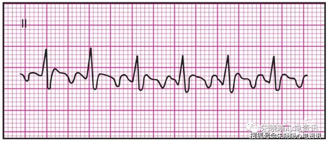 常见的14种异常心电图的波形特点建议收藏
