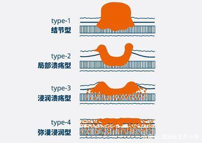 镜下胃癌分型
