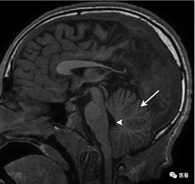汇总:收藏这23个病例,搞定大脑中线处mri诊断_小脑