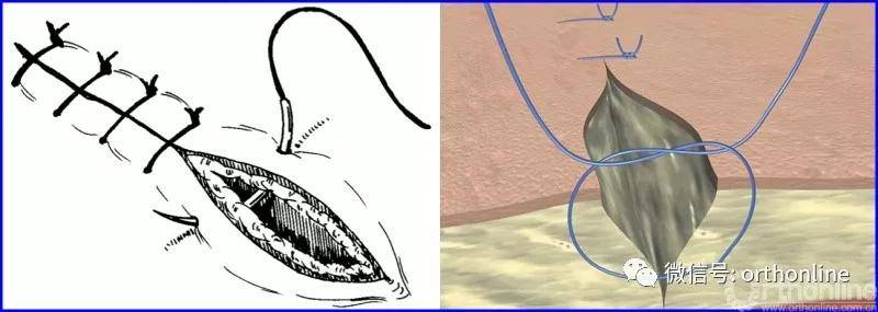 基本上可分为单纯缝合,内翻缝合和外翻缝合3大类,各类又有间断和连续