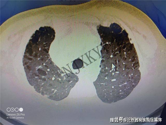 吸了50年的烟,得到是一个千疮百孔的肺和一个癌变的"心"