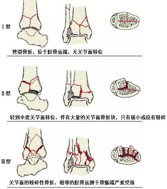 造成关节面内陷,破碎分离,干骺端骨质粉碎,软组织损伤,大部分同时有