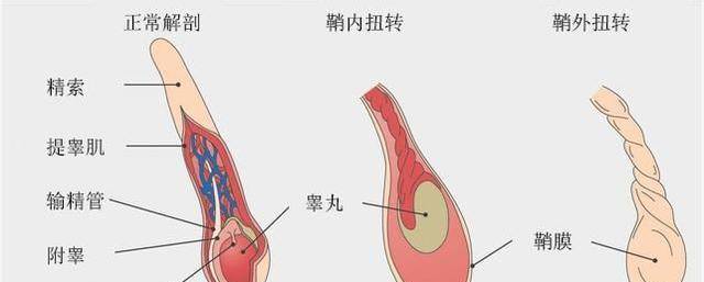 原创蛋疼不是玩笑下腹疼痛当心是睾丸扭转延误治疗只能切除